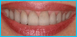teeth whitening